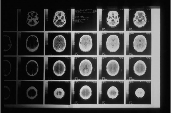 영국 임피어리얼 칼리지 런던(ICL) 종합 암 영상센터 에릭 아보아게 교수 연구팀은 뇌 MRI 영상을 분석, 초기 치매를 10~12시간 안에 진단해낼 수 있는 알고리즘을 개발했다. 사진=CC0